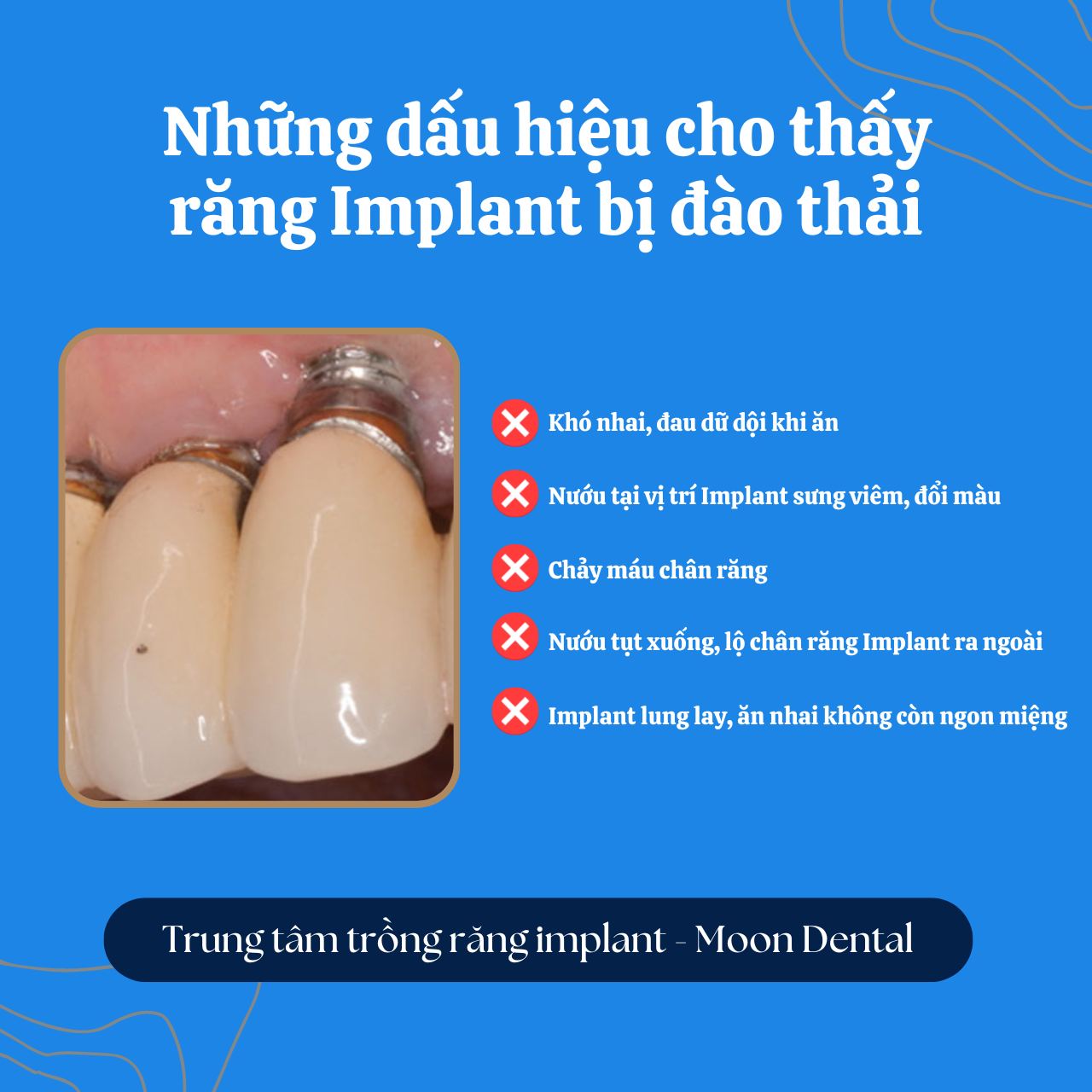 NHỮNG DẤU HIỆU CHO THẤY RĂNG IMPLANT BỊ ĐÀO THẢI