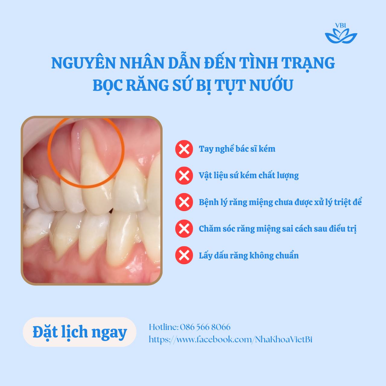 NGUYÊN NHÂN DẪN ĐẾN TÌNH TRẠNG BỌC RĂNG SỨ BỊ TỤT NƯỚU