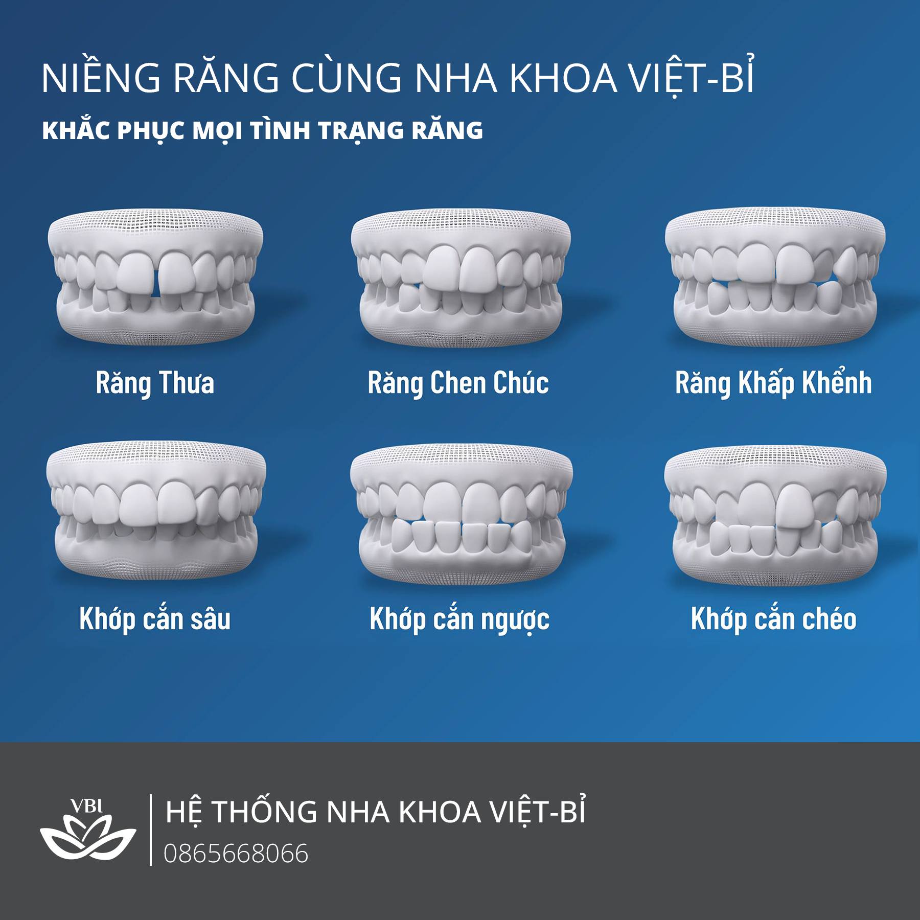NIỀNG RĂNG TRONG SUỐT TẠI NHA KHOA VIỆT BỈ KHẮC PHỤC MỌI TÌNH TRẠNG RĂNG