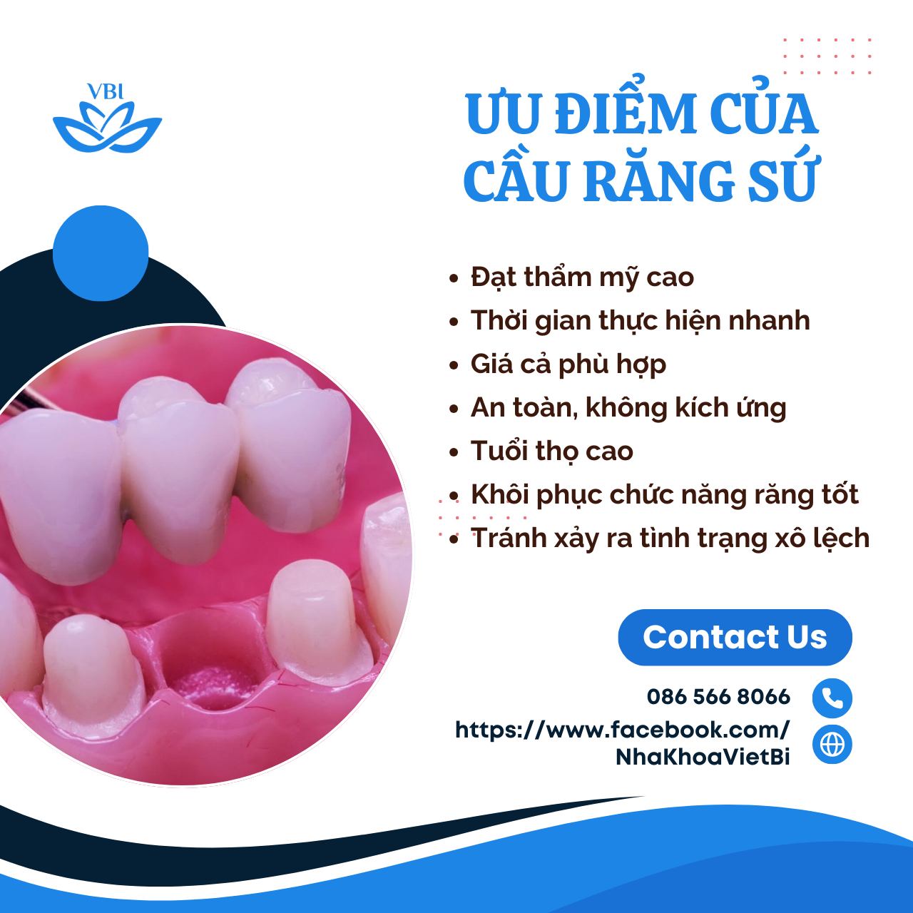 ƯU ĐIỂM CỦA CẦU RĂNG SỨ