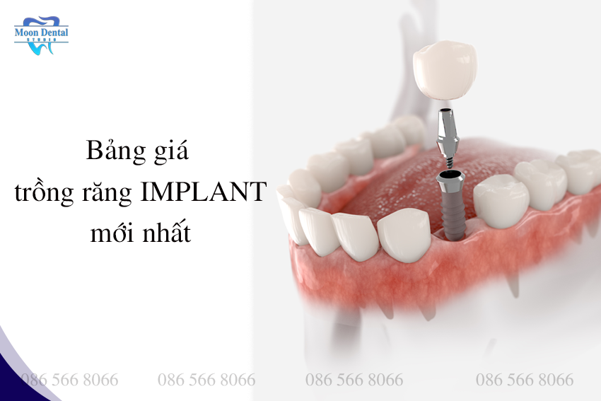 Giá trồng răng implant mới nhất