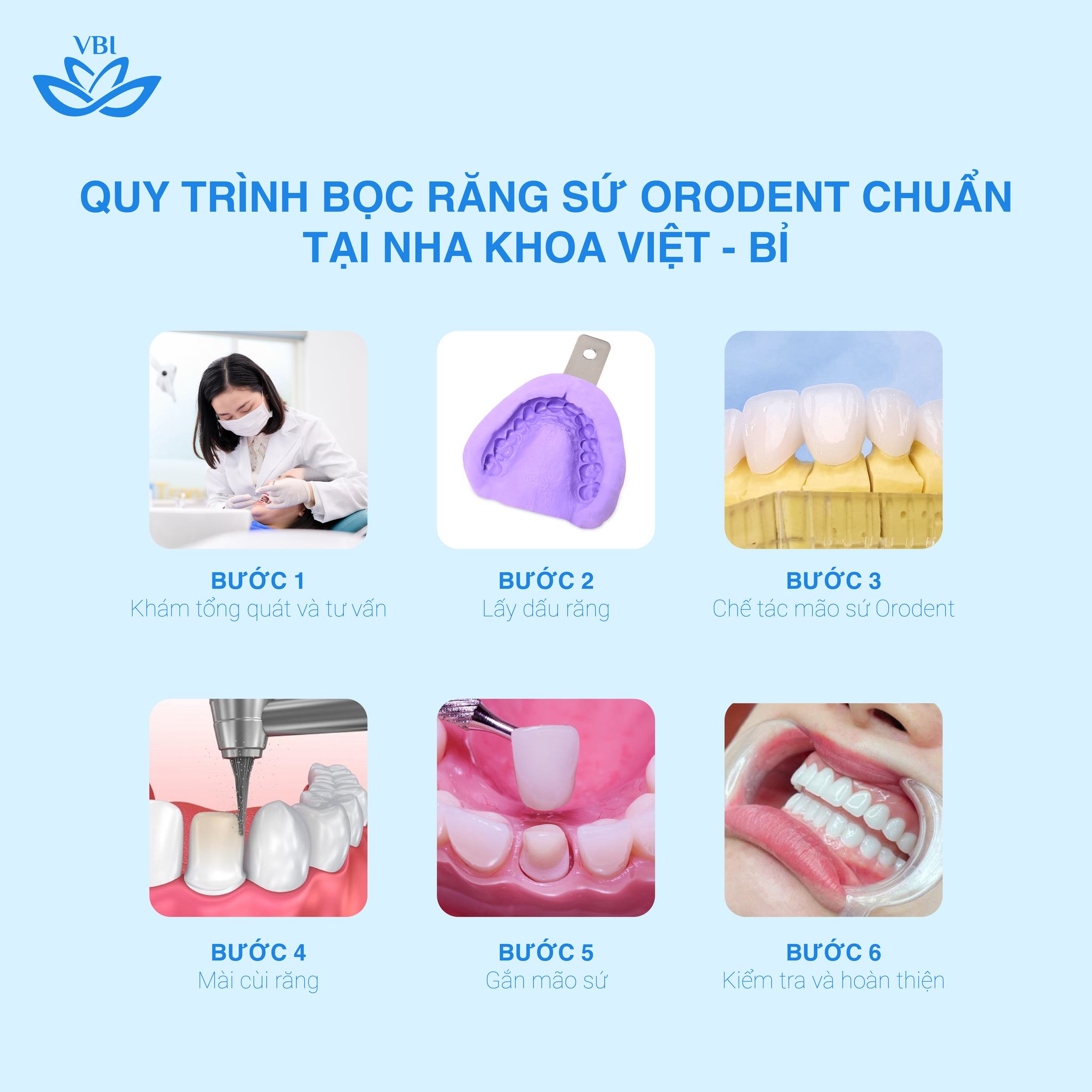 QUY TRÌNH BỌC RĂNG SỨ ORODENT CHUẨN TẠI NHA KHOA VIỆT- BỈ