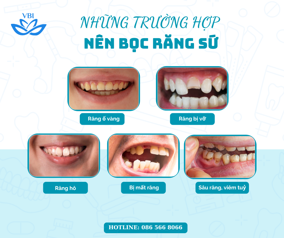 NHỮNG TRƯỜNG HỢP NÊN BỌC RĂNG SỨ