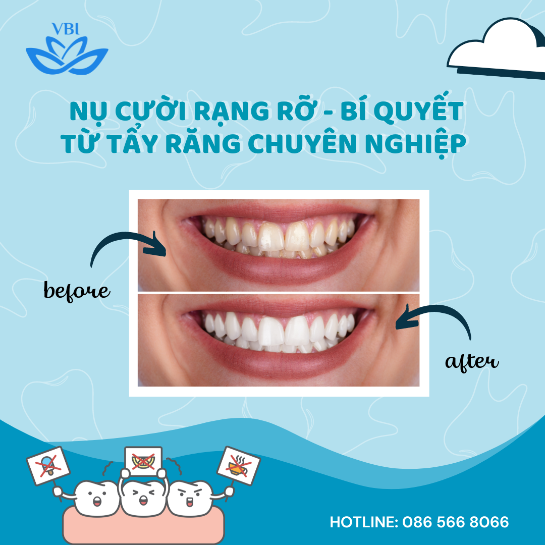 NỤ CƯỜI RẠNG RỠ TỪ TẨY TRẮNG RĂNG CHUYÊN NGHIỆP