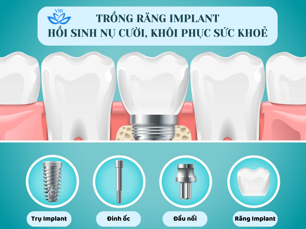 TRỒNG RĂNG IMPLANT: GIẢI PHÁP HOÀN HẢO CHO NỤ CƯỜI RẠNG RỠ