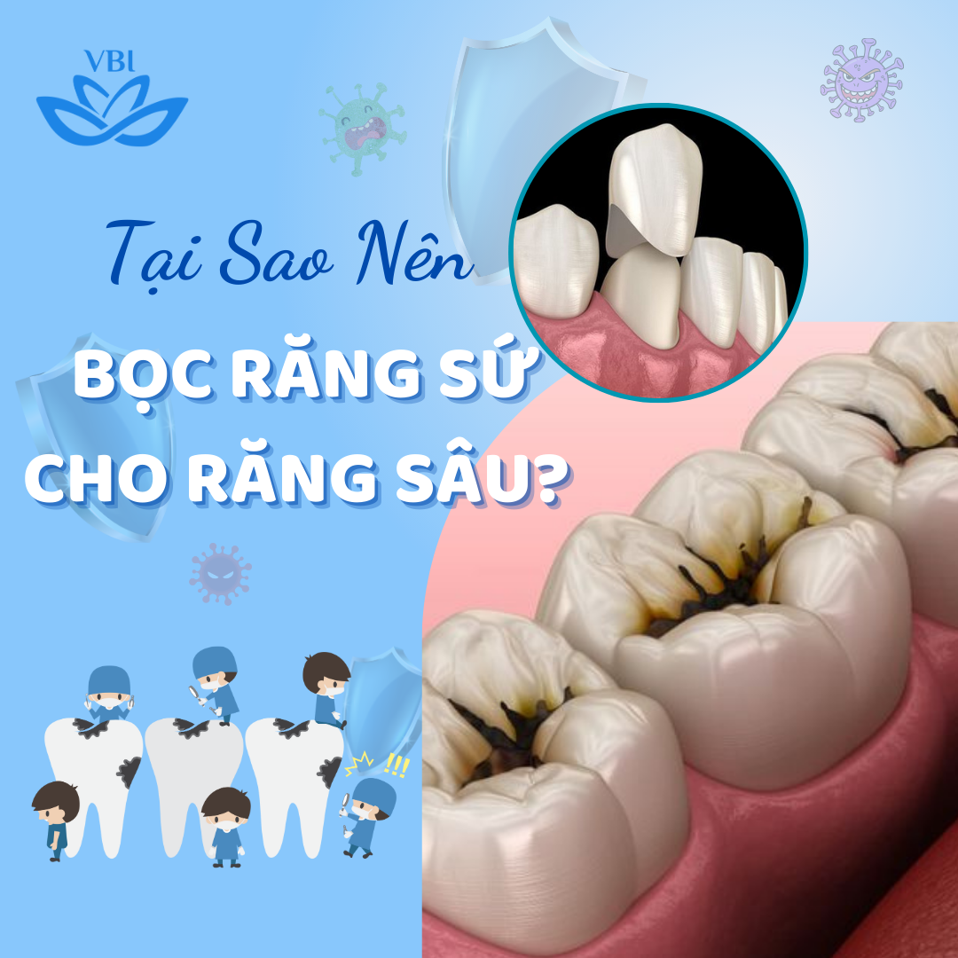 BỌC RĂNG SỨ CHO RĂNG SÂU: GIẢI PHÁP TỐI ƯU CHO NỤ CƯỜI RẠNG RỠ