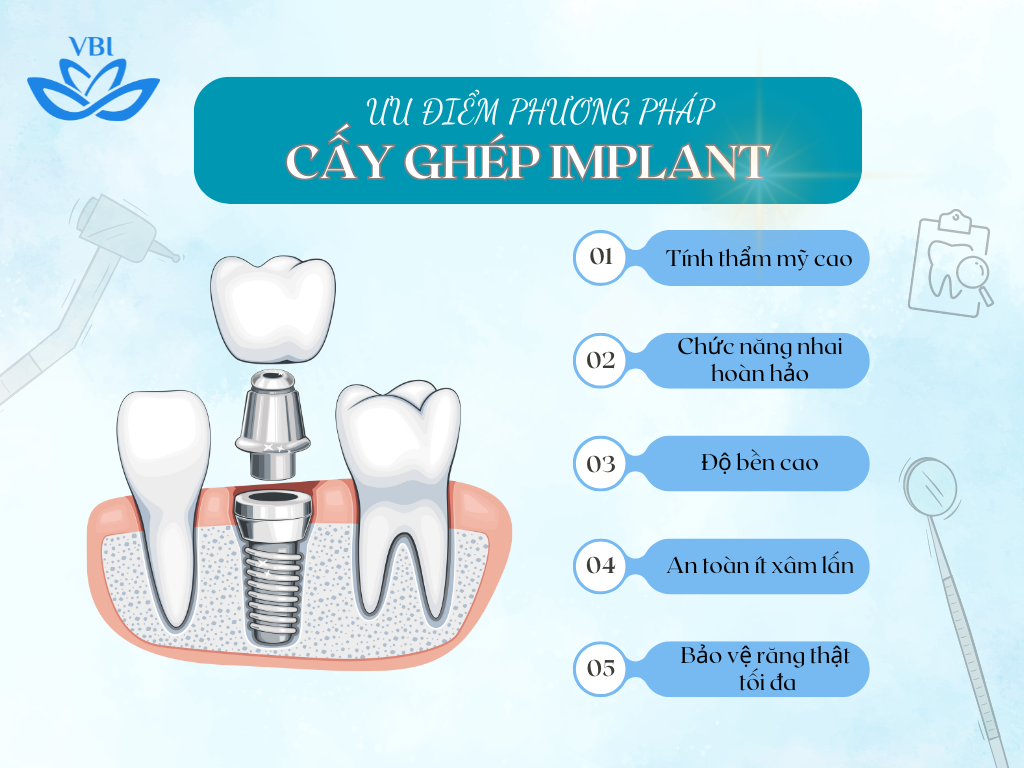 5 ƯU ĐIỂM VƯỢT TRỘI CỦA PHƯƠNG PHÁP CẤY GHÉP IMPLANT