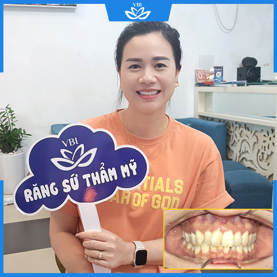 Răng sứ thẩm mỹ không mài nhỏ