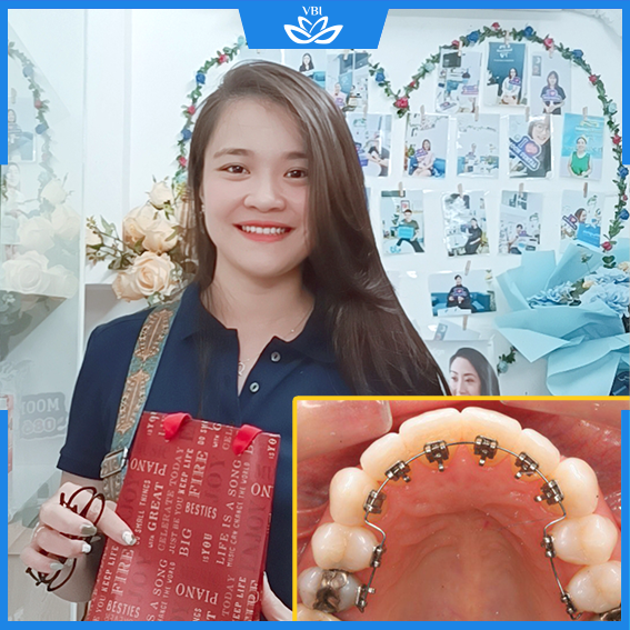 Mắc cài mặt lưỡi