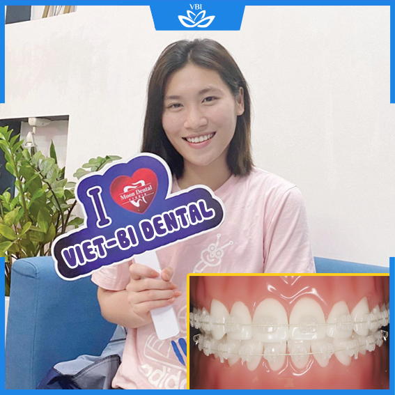 Niềng răng mắc cài sứ