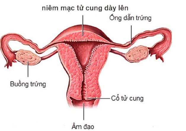 niêm mạc tử cung dày