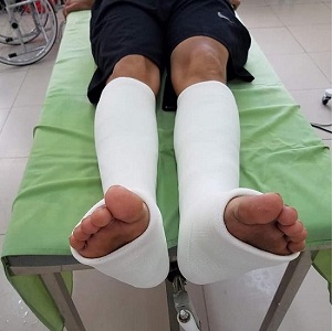 Điều trị bảo tồn gãy xương cẳng chân bằng phương pháp bó bột thủy tinh