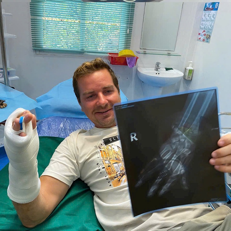 BỘT BÓ SỢI THỦY TINH – GIẢI PHÁP CỐ ĐỊNH XƯƠNG HIỆU QUẢ