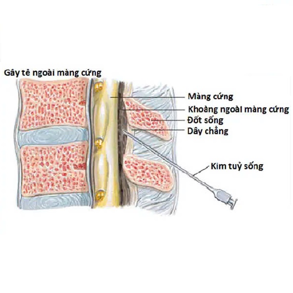 Ưu điểm của gây tê ngoài màng cứng trong sinh mổ