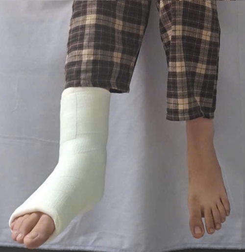 So sánh sự khác biệt giữa bột bó thủy tinh với bột bó thạch cao