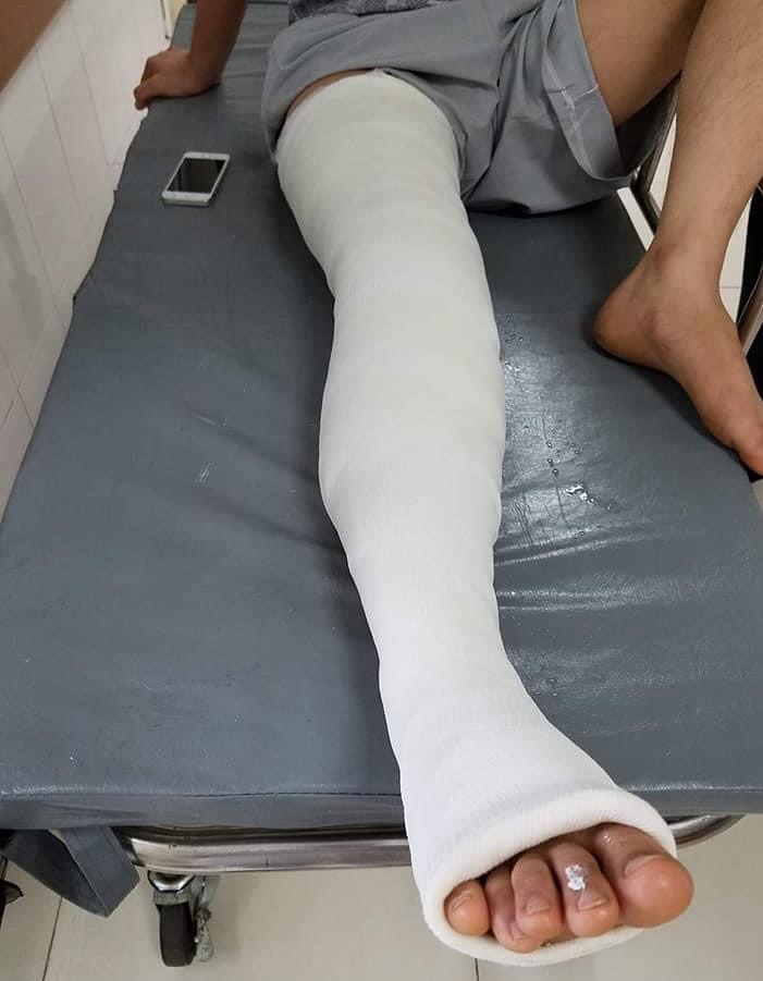 bó bột xương cẳng chân
