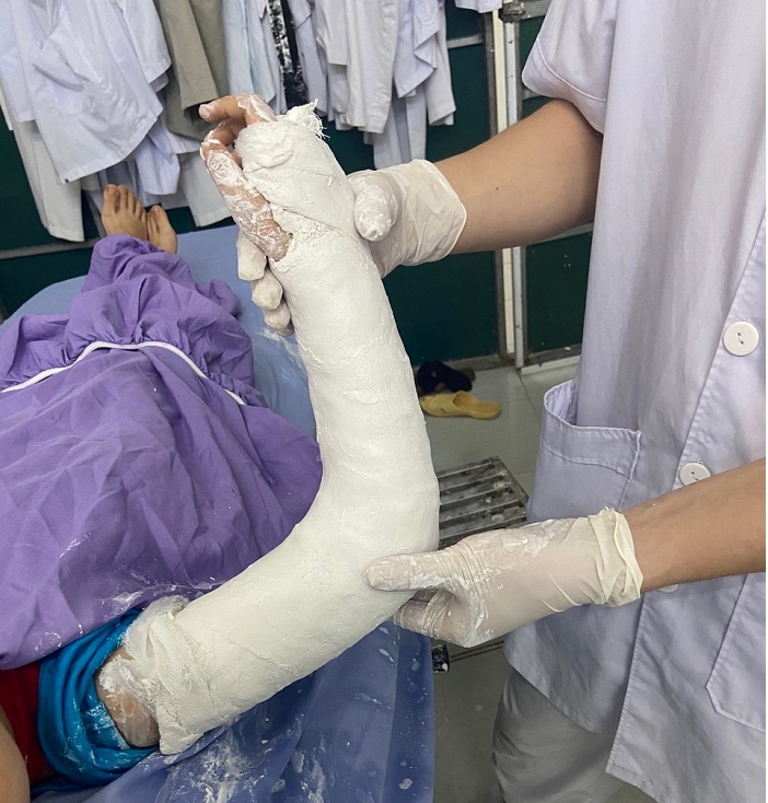 Điều trị bảo tồn gãy thân xương cánh tay