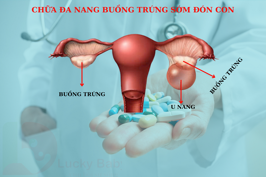 CHỮA ĐA NANG BUỒNG TRỨNG BÍ QUYẾT ĐỂ SỚM CÓ CON