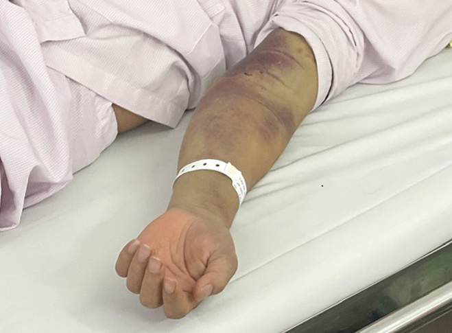 Nhập viện muộn, nhiều người sốt xuất huyết lỡ cơ hội điều trị