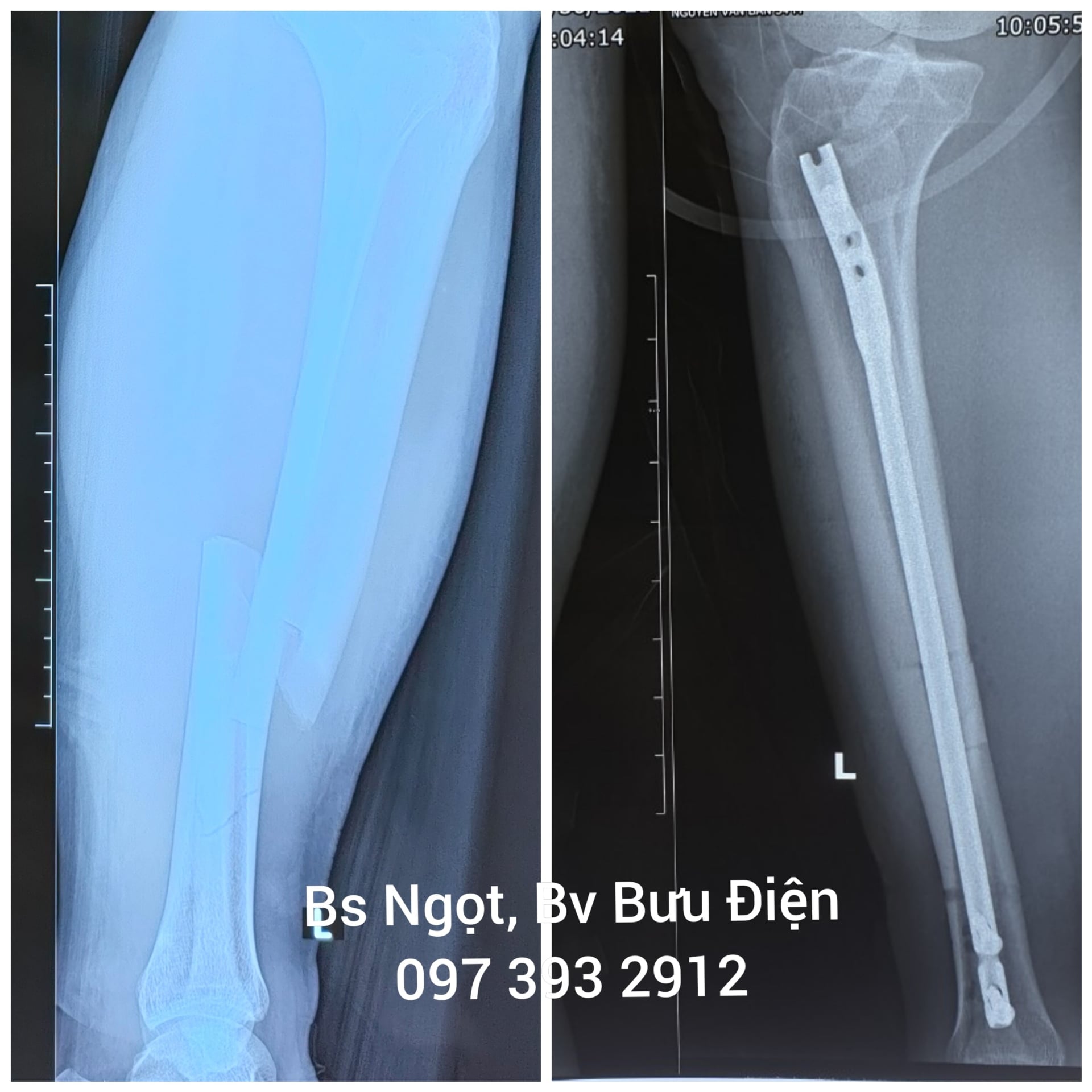 Phẫu thuật kết hợp xương chày bằng đinh nội tủy