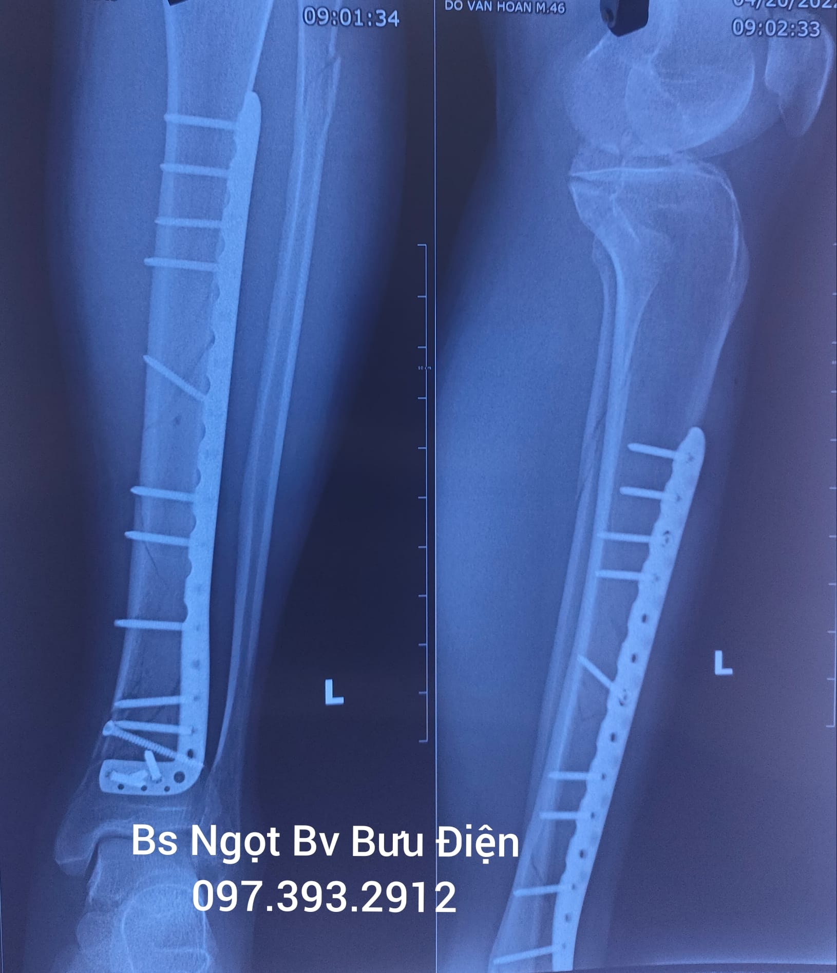 Phẫu thuật kết hợp xương chày bằng nẹp vis