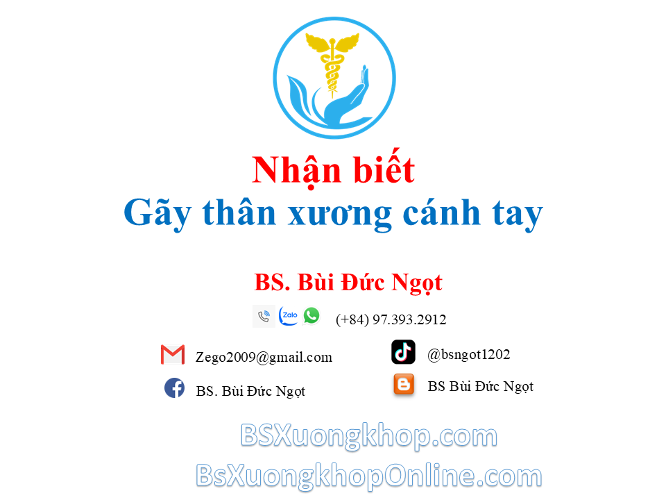 Nhận biết gãy thân xương cánh tay