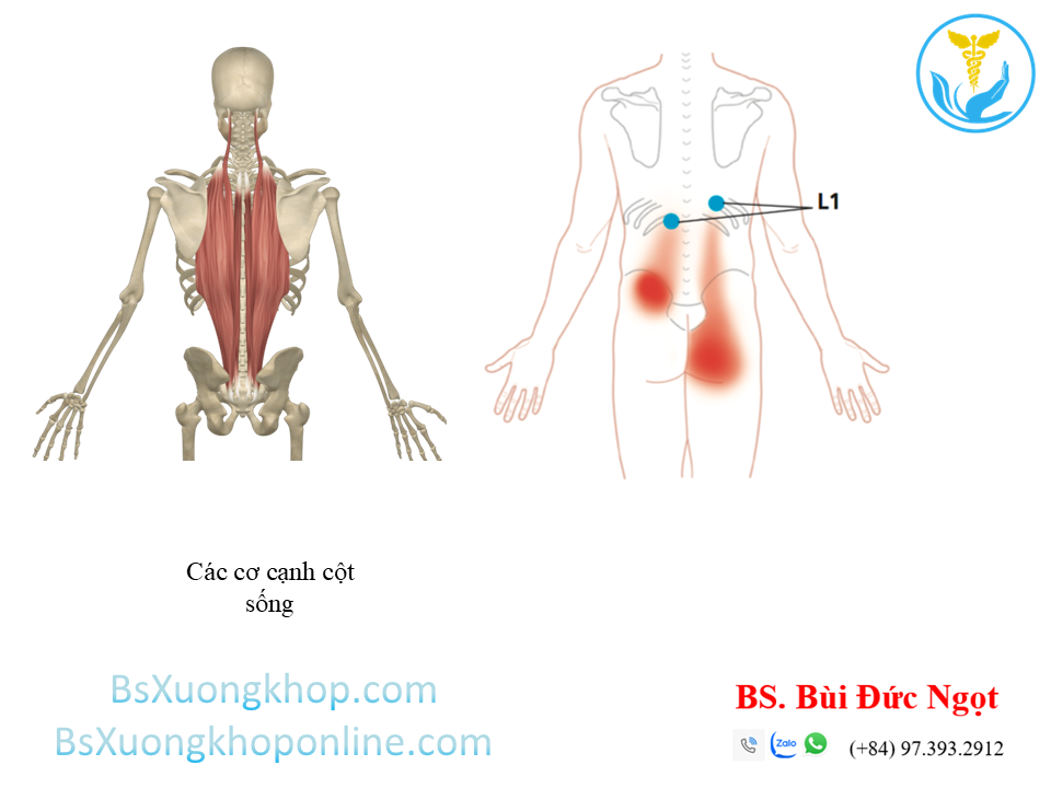 Tổn thương cơ cột sống ||| BsXuongkhop.com