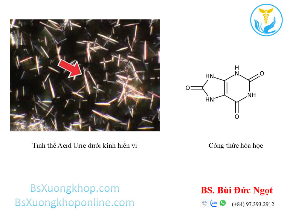 Rối loạn chuyển hóa Acid Uric ||| BsXuongkhop.com