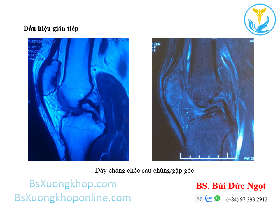 Dấu hiệu gián tiếp gợi ý đứt DCCT trên phim cộng hưởng từ 2