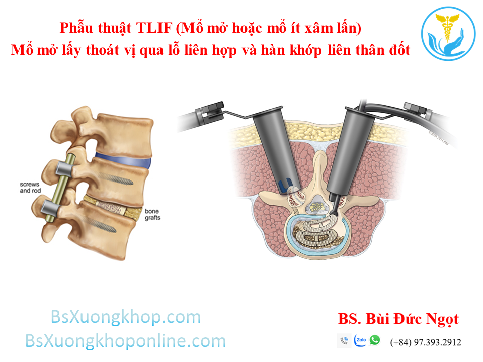 Phẫu thuật lấy thoát vị qua lỗ liên hợp và hàn khớp liên thân đốt