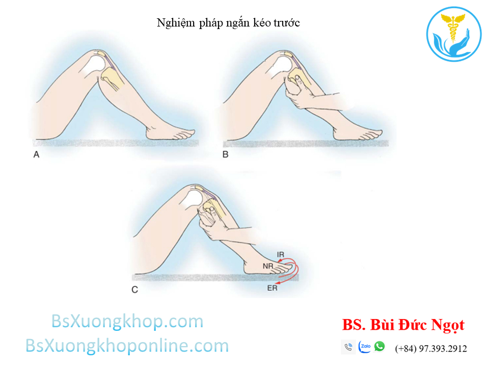 Nghiệm pháp ngăn kéo trước