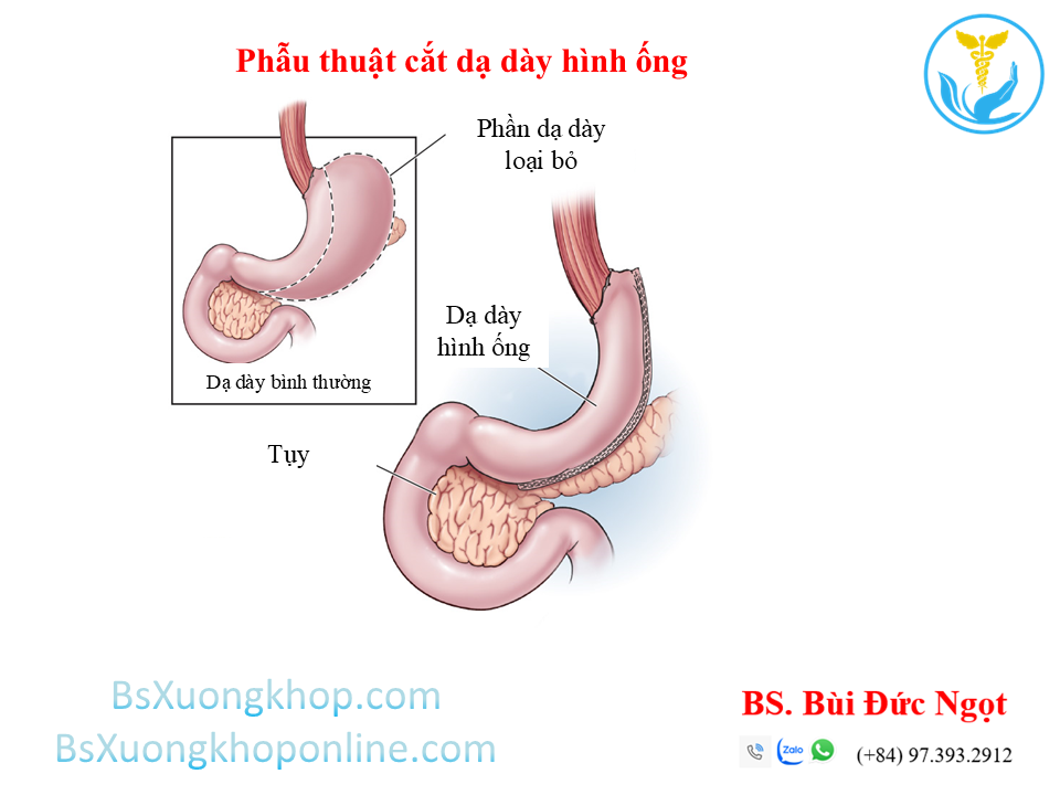 Phẫu thuật Giảm cân là gì? Các kiến thức cơ bản ||| BsXuongkhop.com