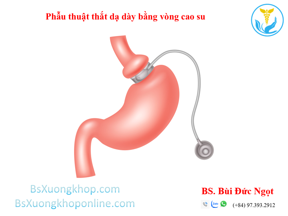 Phẫu thuật Giảm cân là gì? Các kiến thức cơ bản ||| BsXuongkhop.com