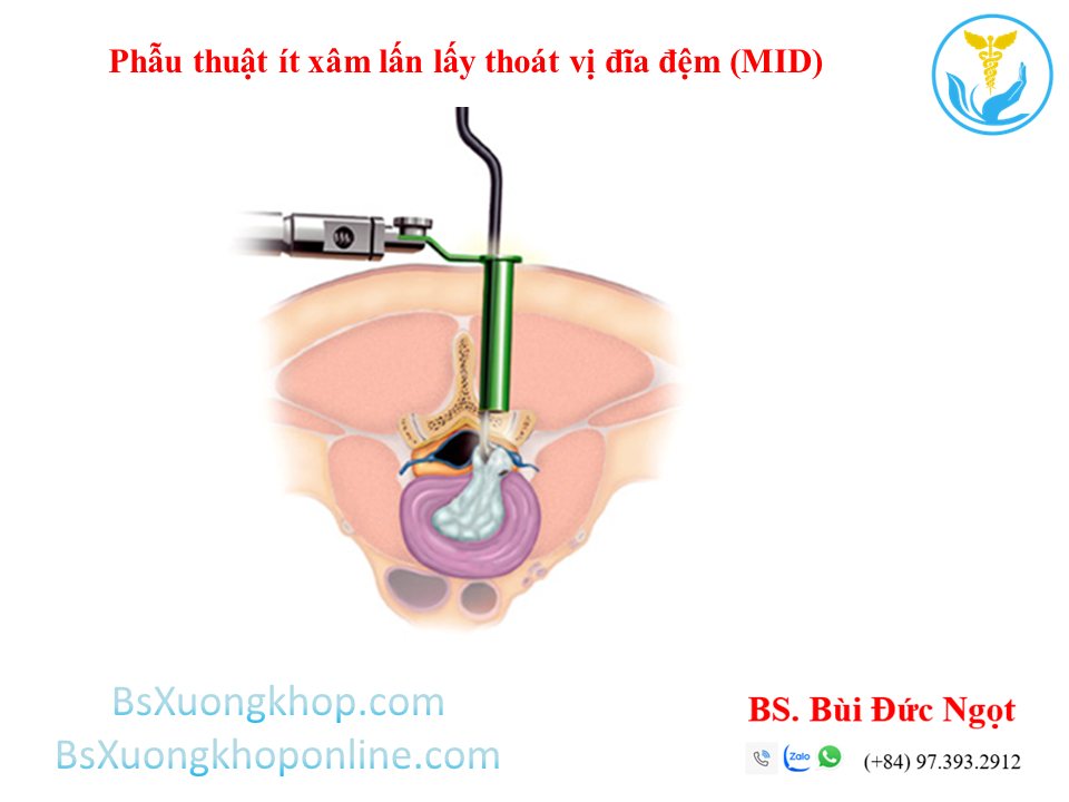 Phẫu thuật ít xâm lấn lấy thoát vị đĩa đệm