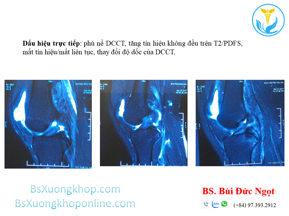 Dấu hiệu trực tiếp gợi ý đứt DCCT trên phim cộng hưởng từ
