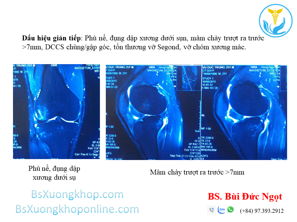 Dấu hiệu gián tiếp gợi ý đứt DCCT trên phim cộng hưởng từ