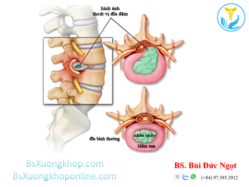 Thoát vị đĩa đệm cột sống thắt lưng là gì? Triệu chứng & cách điều trị ||| BsXuongkhop.com