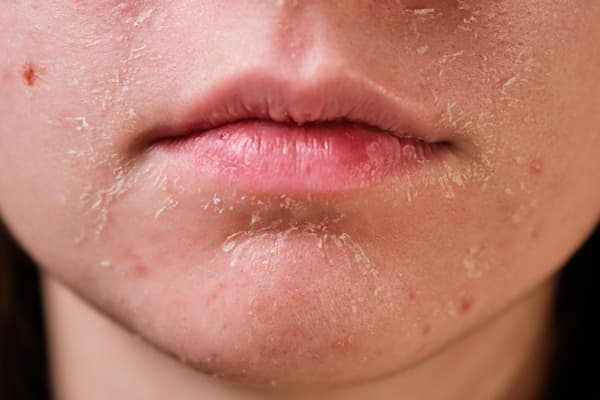 Purging là gì? Nên làm gì khi da bị purging?