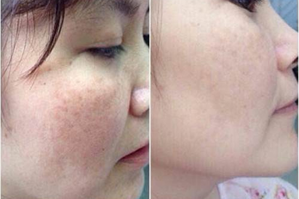 Cặp kem mờ nám mảng Kamel Melasma Cream Chính Hãng