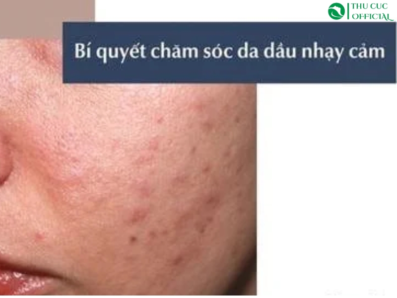 Bí quyết chăm sóc da dầu nhạy cảm