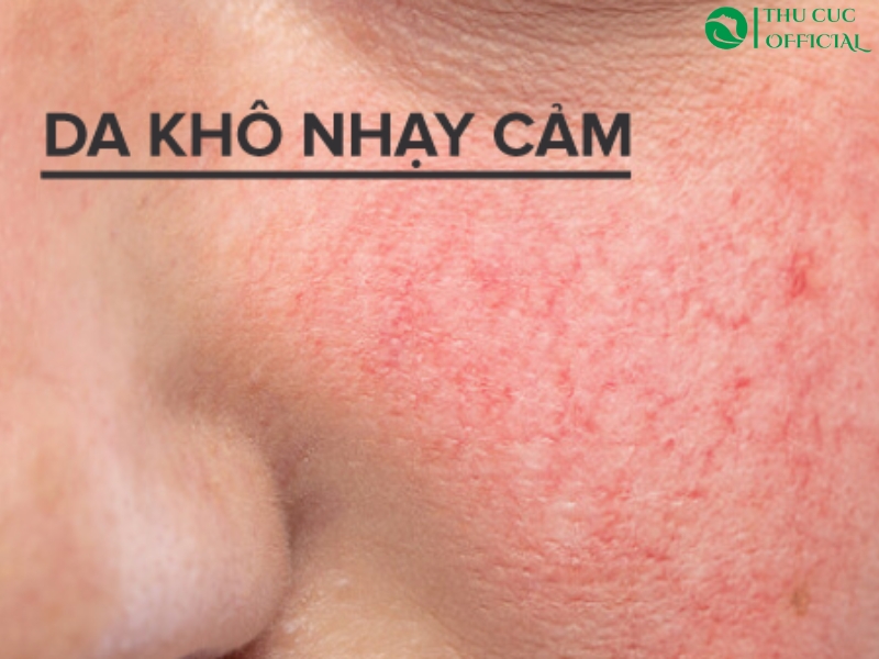 Chăm sóc da khô nhạy cảm