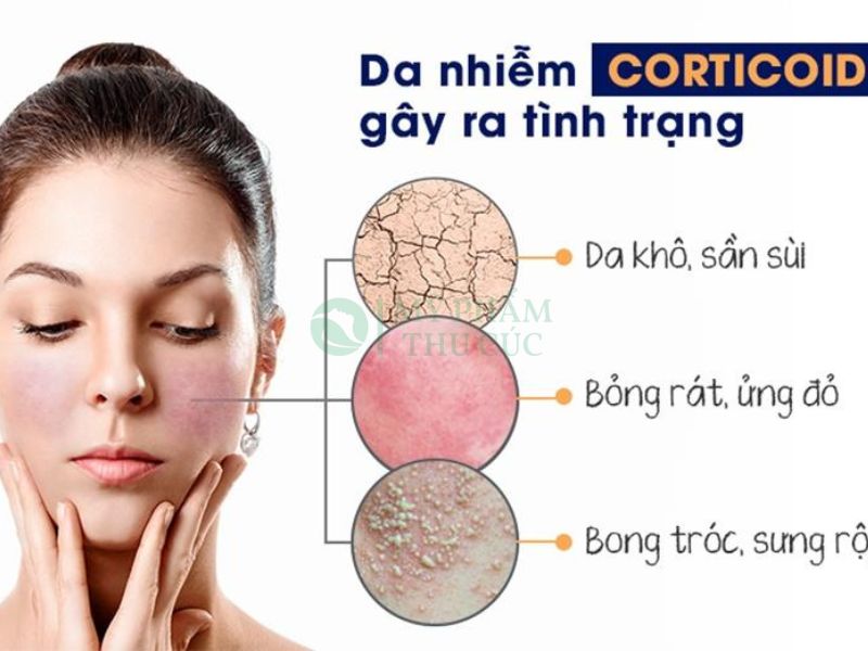 Phục hồi da nhiễm Corticoid