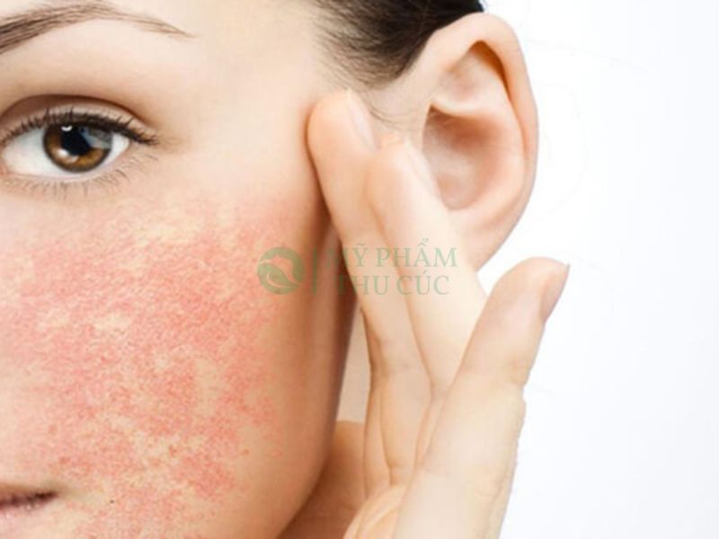 Điều trị da nhiễm Corticoid