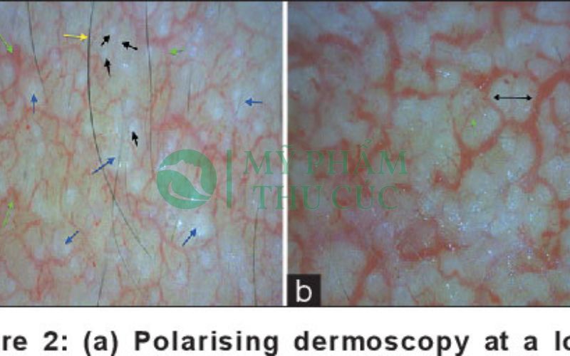 ảnh soi da bị nhiễm corticoid 