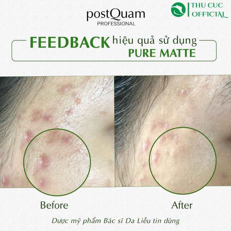 Phản hồi sau sử dụng PostQuam Pure Matte (Q13) 