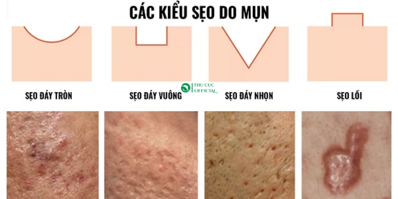 Xác định tình trạng sẹo