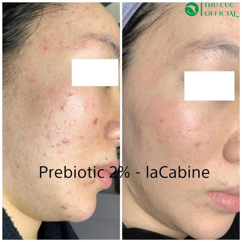 Phản hồi khách hàng sau khi dùng LaCabine 2% Prebiotic 