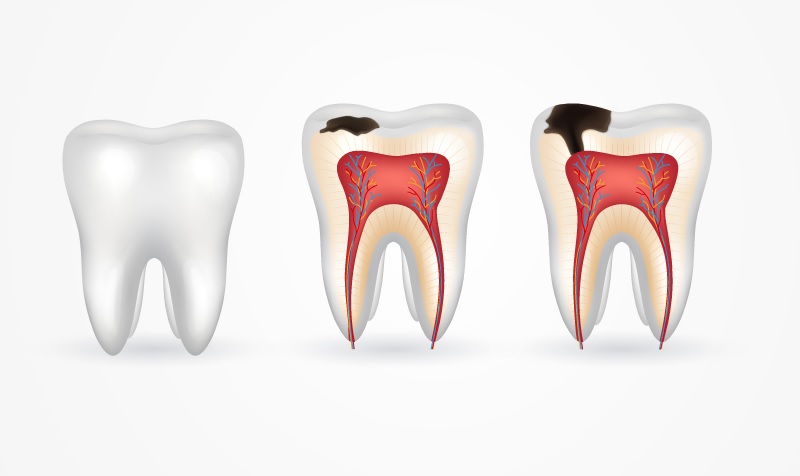 Nguyên nhân gây sâu răng phổ biến và cách phòng ngừa hiệu quả