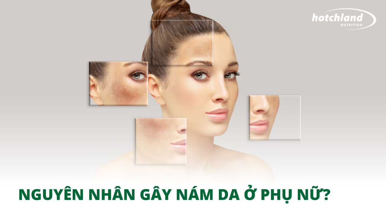 Đâu là những nguyên nhân gây nám da phổ biến ở phụ nữ?