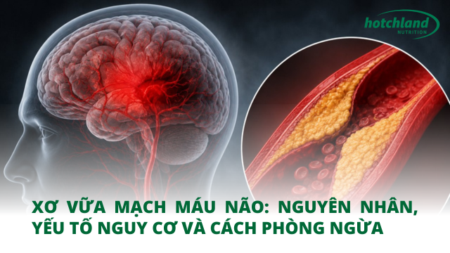 Xơ vữa mạch máu não: Nguyên nhân, yếu tố nguy cơ và cách phòng ngừa